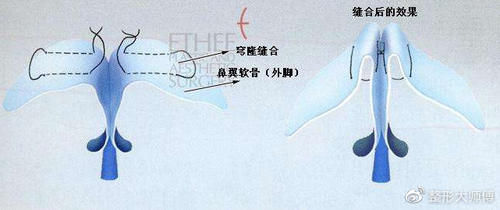  『医用固体硅』鼻尖整形用假体好还是软骨好