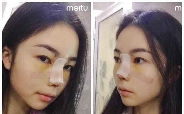  #术后#隆鼻真的有用吗？鼻综合术后六个月记录，这完全不是一个人！