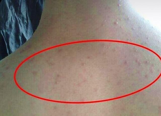 后背时不时抠出“黄色小米粒”，多半螨虫暗潮蠕动，赶紧用这3招