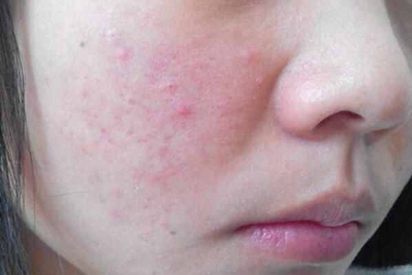 脸上螨虫“做巢”，会有4大表现，夏天除螨用3招，除粉刺消痘痘