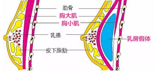  双平面植入：隆胸后胸部手感宛如天然——假体“藏”哪儿？