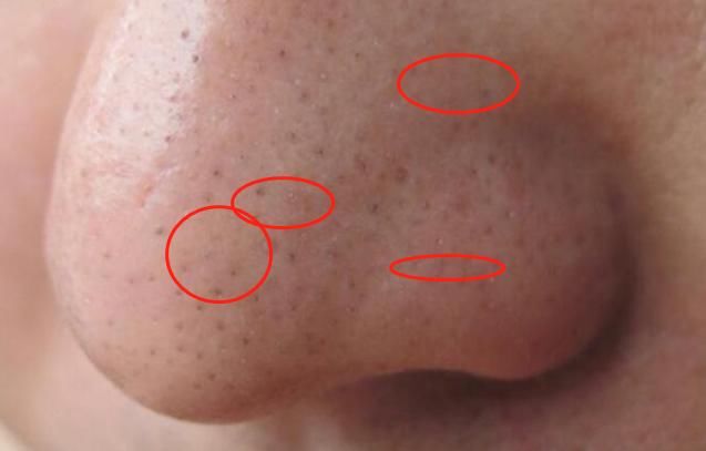 终算找到脸上螨虫的“死对头”了！学会3妙招，清空千万螨虫