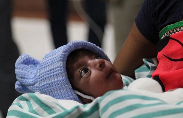 印度男婴拥有四条腿,看起来怪异,却被称作上帝