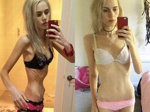 150斤女子因减肥患厌食症，体重剩下70斤，全身上下是骨头!