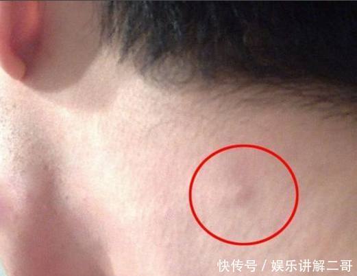 有些身体出现的症状是艾滋病的前兆,你知道吗