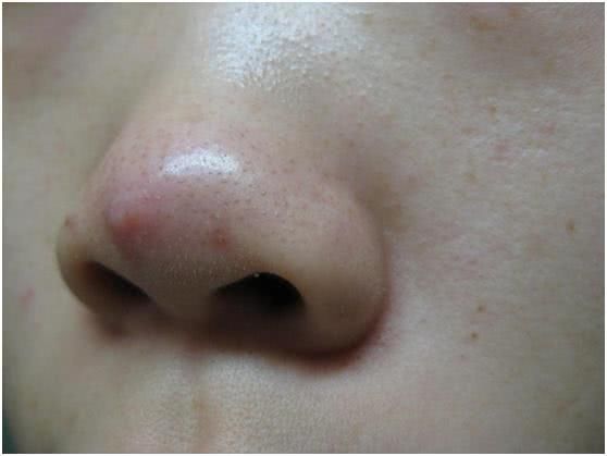 这3个症状就是螨虫脸,只要有1个就危险了!赶紧