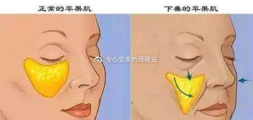  求美者来说■“苹果肌”打造全攻略！