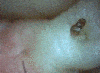 鼻子上为什么会有黑头？本文黑头图片高能警报，没做好准备勿看！