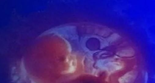 女孩右腹隆起,父亲带她去检查,胃里有个胚胎,医