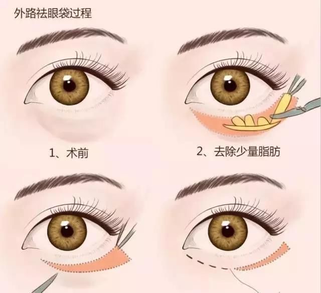  「上睑下垂」除了割双眼皮，还能如何改善自己的眼睛？