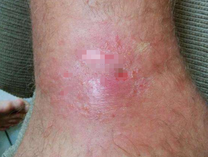 男子脚上痒了一段时间,到医院一检查,取出的东