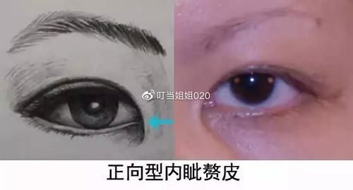  【内眦赘皮矫】需不需要看眼角……请对号入座