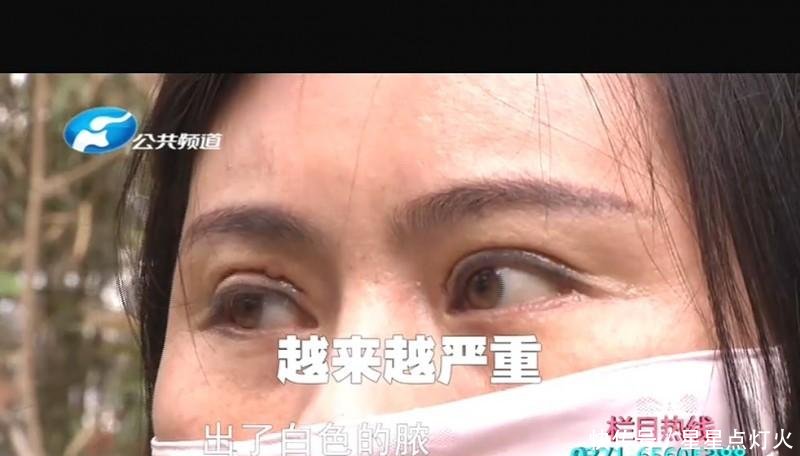  医院工作人@郑州东方整形想要修复双眼皮 谁料眼上起脓包