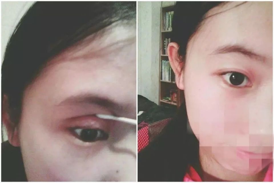 双眼皮“黄金不败宽度”来了!某璐要是早看到也不至于割完眼皮又