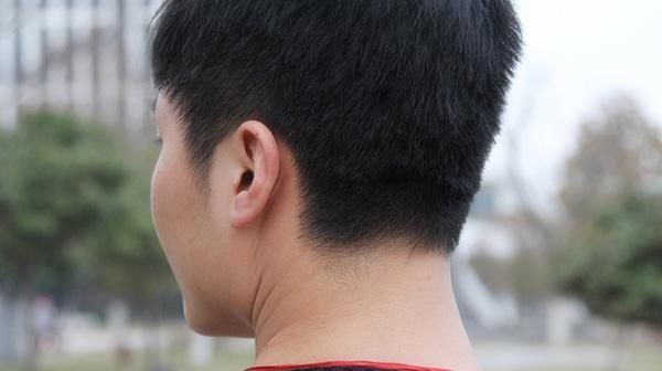  #上长#皮肤上长了小肉疙瘩,是什么东西?会恶变吗?该怎么处理?
