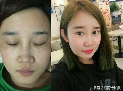 阿莫西林磨成粉，和药店里的它混合，擦擦脸，面色光滑细腻