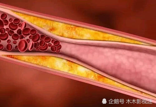 动脉硬化会有五个早期症状，超过两个，要抓紧检查一下