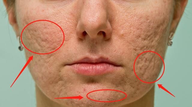 脸上的毛孔像一个个坑，说明过亿螨虫在爬钻咬，用这3招来“补救