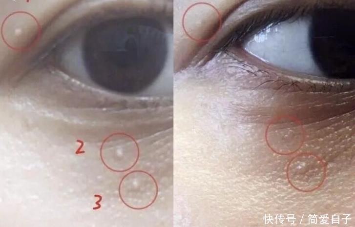  清洁■眼睛下面黄色颗粒，是皮肤清洁不到位？常长脂肪粒其实另有原因！