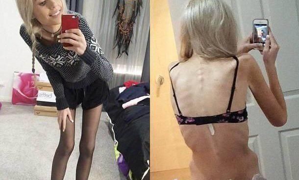 150斤女子因减肥患厌食症，体重剩下70斤，全身上下是骨头!