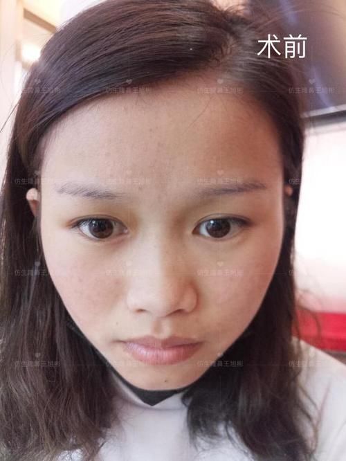  术后■鼻头肥大、山根低、没鼻梁，肋软骨隆鼻后变化有多大？