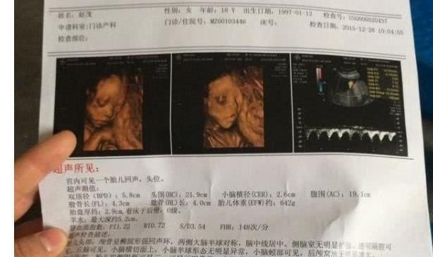 『肚子』B超单3个孕检“数据”，暗示肚子里是“小王子”，你占了几条