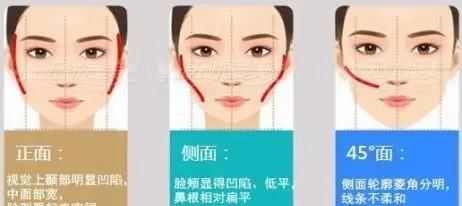  「颧弓」面部轮廓整形之“颧骨颧弓”
