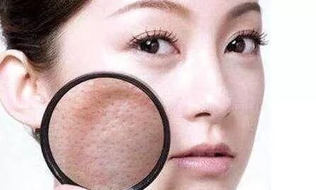 年纪不大却毛孔粗大，不要小看，是螨虫把毛孔撑大，3招扫空螨虫