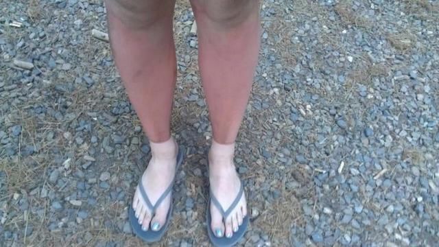 英国100年来最热夏天？别再去晒日光浴了！