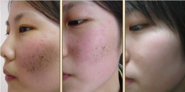 维生素E和“它”掺到一起,祛斑美白,坚持一月,斑点如雨下