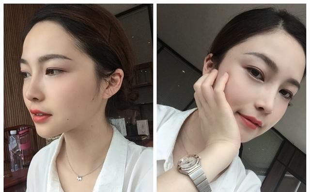  #术后#隆鼻真的有用吗？鼻综合术后六个月记录，这完全不是一个人！