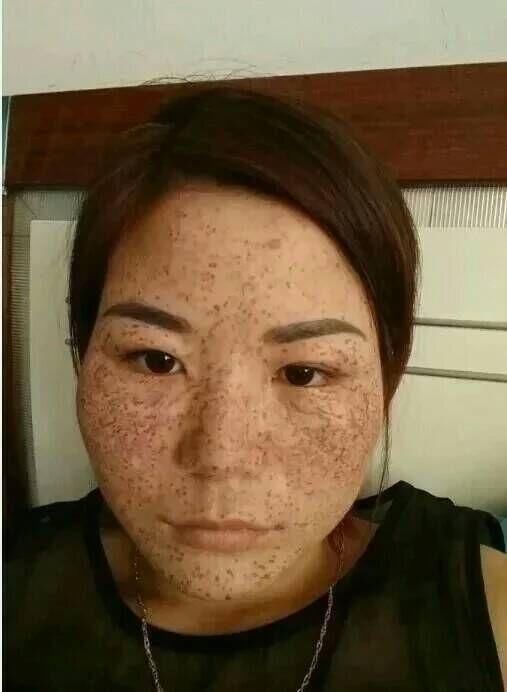 真实祛斑的几种办法和斑说拜拜