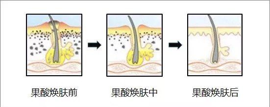 几十块就能收毛孔!这支超好用的“磨皮原液”，连我的黑头也治好