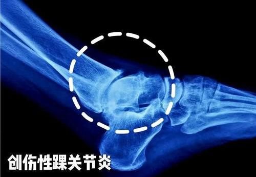  『韧带撕裂』崴脚脖子只要能走就没大事儿？医生辟谣：韧带损伤请不要忽视！