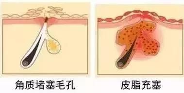 开口闭口粉刺，识别黑头白头……了解这些你冒痘的脸还有得救！