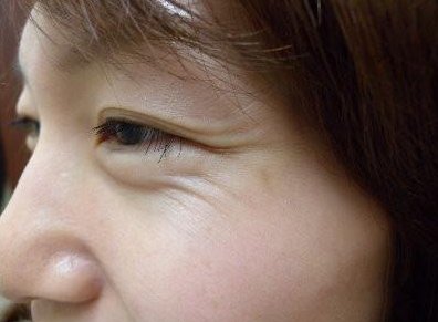 皮肤科教授透露:睡前抹点药店“白菜价乳膏，脂肪粒、眼袋去无影