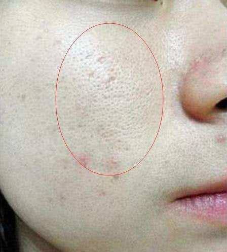 为什么偏偏就你毛孔比较粗大?天天在做这3件事,毛孔不粗大才怪