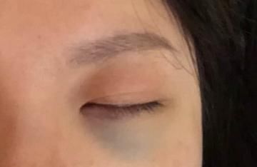 了去■割眼袋多久恢复自然呢?我亲身经历了去眼袋手术恢复的点点滴滴