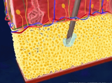  抽脂@抽脂成为当下女性减肥潮流，抽脂减肥：想怎么瘦，就能怎么瘦？
