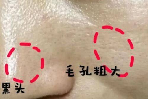  「油脂」毛孔粗大难看又显老,毛孔粗大怎么办收缩毛孔妙招