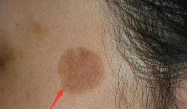 女人过了40岁,当脸上长出斑点,用这一个土方法,可以淡化斑点