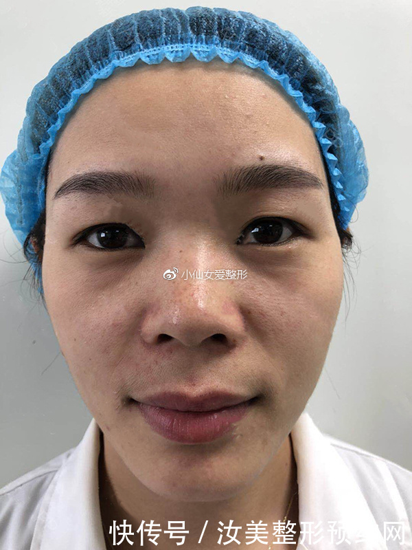 开内眼角前后对比照片,不灵不灵的大眼睛也着实的迷人