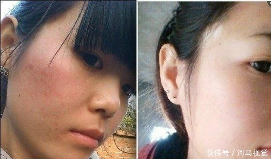  『奶奶』脸上的色斑太难看？奶奶传授的终极祛斑法，美白效果太明显！