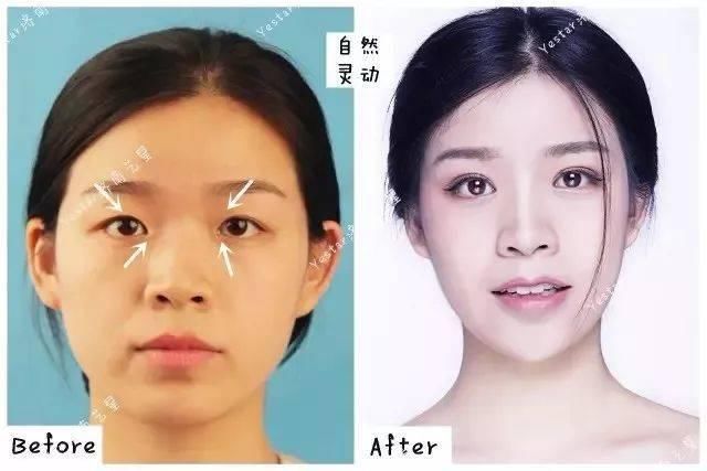  济南■「济南艺星双眼皮」别傻了！这种“无痕双眼皮”其实就是……