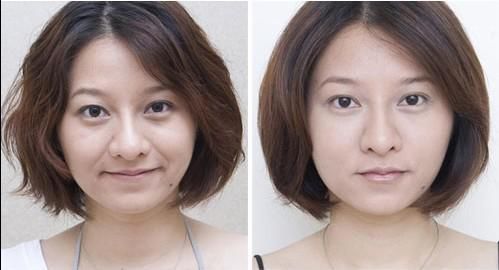 做玻尿酸除皱价格要多少