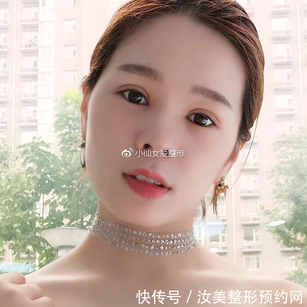 开内眼角前后对比照片，不灵不灵的大眼睛也着实的迷人