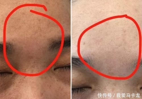 「毛孔粗大」女生脸上毛孔大到能插秧?教你3个小窍门,助你皮肤Q弹似果冻