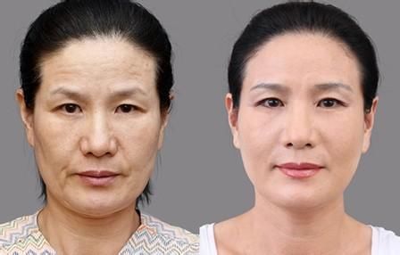 做光子除皱价格要多少