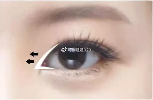  【内眦赘皮矫】需不需要看眼角……请对号入座