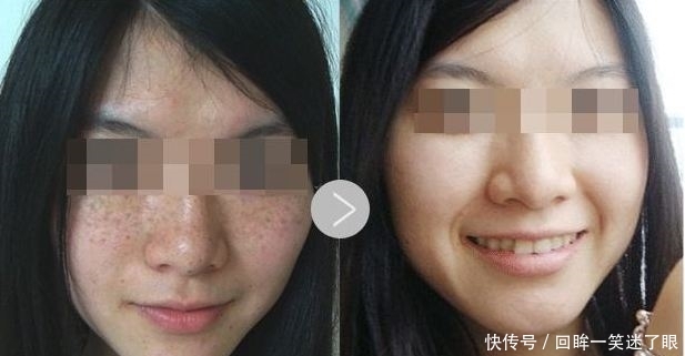  脸部■蜂蜜加它涂抹脸部，一周两三次轻松赶走黑色素，半个月恢复白净肌